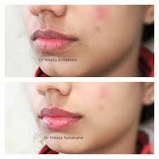 Lips Bright Pro